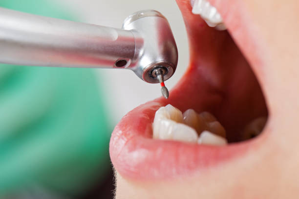 Best Dentist for Tooth Abscess  in Steamboat Springs, CO